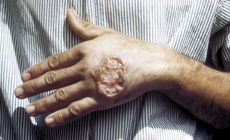 lesmaniasis